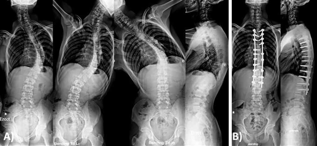 B.Elnadyetal.:SICOTJ2017,3,69 3 Figure1. Malepatient17yearsoldwithLenke1an.(A)PreoperativeX-raysshowingmainthoraciccurveof50 thatwascorrected to 29 in side bending films with thoracic kyphosis of 40.