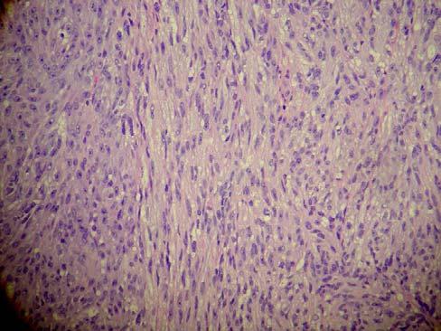 Figure 4 Under simple H&E (Hematoxylin eosin) stains. Slide 1 in low power, reveals melanoma cells around a Pacinian corpuscle.