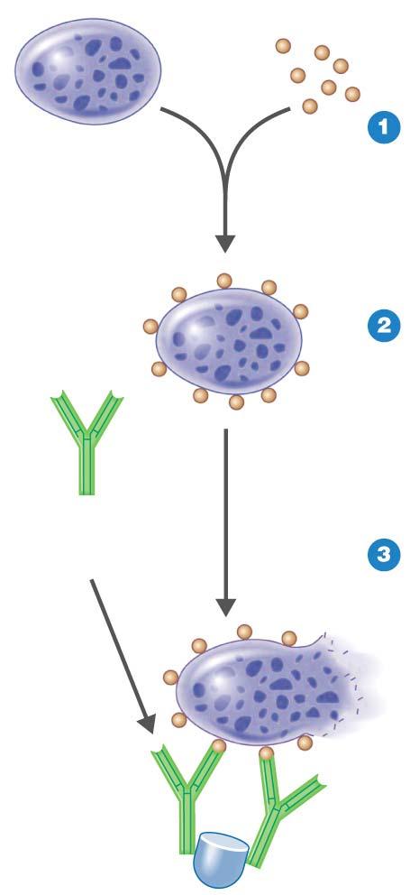 Drug-induced thrombocytopenic purpura. Platelet Drug (hapten) Drug binds to platelet, forming hapten platelet complex.