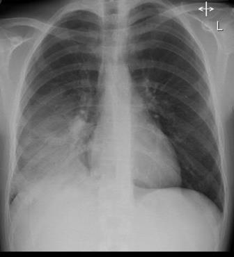 Pneumonia Lobar pneumonia Bronchopneumonia (Non lobar)