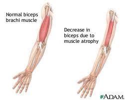 to return to its initial length after being stretched Atrophy-loss of muscle mass Hypertrophy
