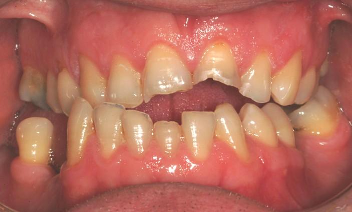 What is Tooth Wear? Tooth wear refers to the loss of tooth substance that is not caused by dental caries or trauma. Almost all patients have some minor tooth wear which does not cause any problems.