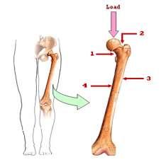 femur fracture happens due to either a large force or something is wrong with the bone. In patients, the most common causes of femur fractures include: Car accidents and falls from a height.
