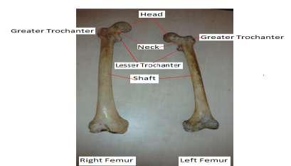 The following four proximal femur fractures are commonly referred to as hip fractures: 1.Femoral head fracture 2. Femoral neck fracture 3.Inter-trochanteric fracture 4.Sub-trochanteric fracture.