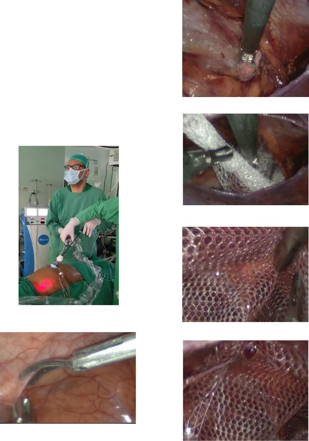 The patient was placed in a 30 Trendelenburg position, which caused the small bowel loop to move up and allowed for complete visualization of the surgical field with 5 mm, 30 scope.
