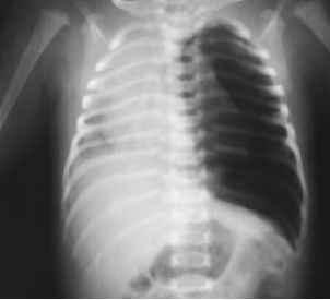 - Case 2: tension pneumothorax in the left side with chest X-ray showing shift of mediastinum, presence of air in the pleura and collapsed left lung (as seen in the image below): How would you manage