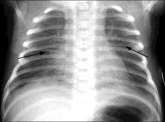 How would you manage this case? There will be a spontaneous recovery after 48 hours. - Case 4: a term baby with cyanosis, tachypnea and retractions. Chest X-ray shows nonhomogenous opacity of lungs.