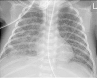 If the case represents congenital pneumonia: Most common pathogens are: GBS, Gram (-) bacteria and Listeria monocytogens.