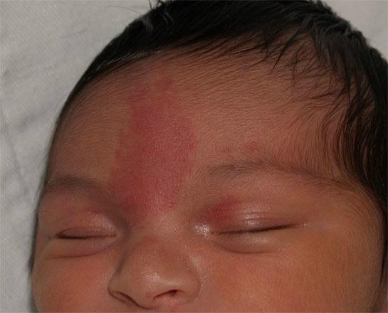 - Case 6: a 6 months infant presents to your clinic with the following spots which are nontender, not rising above the surface of the skin and has a homogenous color (no different stages of colors