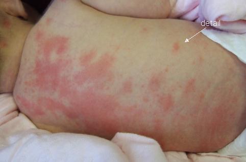 - Case 7: an infant presents to your clinic with the following: Salmon patch (capillary hemangioma). It is considered as a birth mark and is seen on eyelids, occiput and forehead.