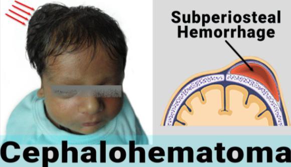 - Case 10: you must differentiate between cephalohematoma and caput succedaneum: Caput succedaneum Cephalohematoma Nature Subcutaneous, extraperiosteral