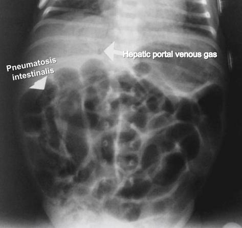 - Case 15: a 2 weeks old preterm who presents with abdominal distention and bloody stool.
