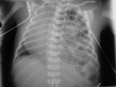 Intrahepatic portal venous gas. Pneumo-peritoneum (gas under the diaphragm) if perforation occurs.