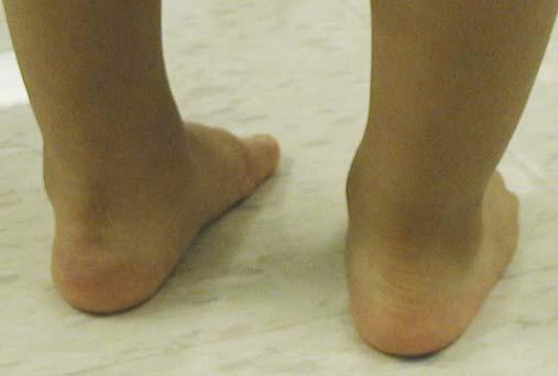 1197 Fig. 5-C Fig. 5-D Three years after correction of the vertical talus, a clinical photograph demonstrated a neutral appearance of the right hindfoot (Fig.