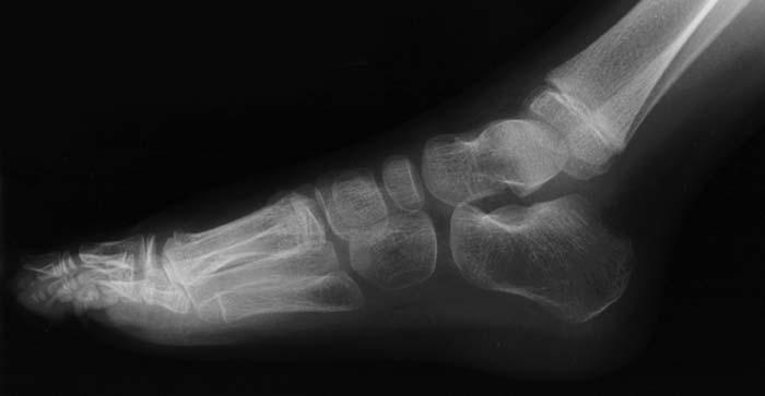 All patients required percutaneous Achilles tendon lengthening for correction of the hindfoot equinus.
