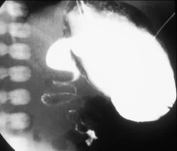 Abnormal Findings: Duodenojejunal junction to the right of the spine Obstruction of