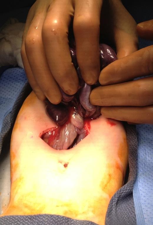 segments or entire midgut Limited resection