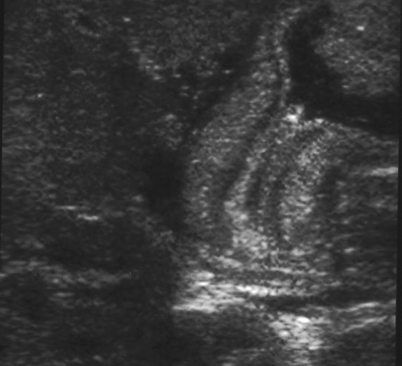 Ultrasound 5 Diagnostic criteria: Muscle thickness: > 3 mm