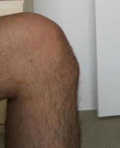 Osgood-Schlatter s Affects tibial tubercle apophysis Ages 10-14 Up to 30% will have bilateral involvement Usually due to