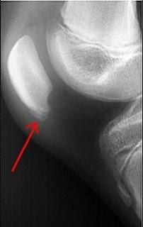 Sever s Disease Affects calcaneal apophysis Worse with activity,