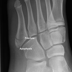 Iselin s Disease Affects base of the fifth metatarsal where the peroneus brevis attaches Ages 8-14 Usually insidious onset but may start after an ankle injury (inversion) Point TTP at base, may be