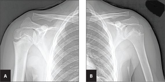 Little Leaguer Shoulder Injury to the proximal humeral physis due to repetitive stress Mimics a Salter Harris I fracture Males ages 11-14 Presents with pain with overhead throwing, decreased throwing