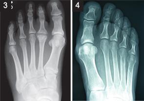 Freiberg Disease Affect the head of the second metatarsal Causes pain in forefoot, exacerbated by weight-bearing and athletic activities Often seen in adolescent females and dancers Bilateral in <10%
