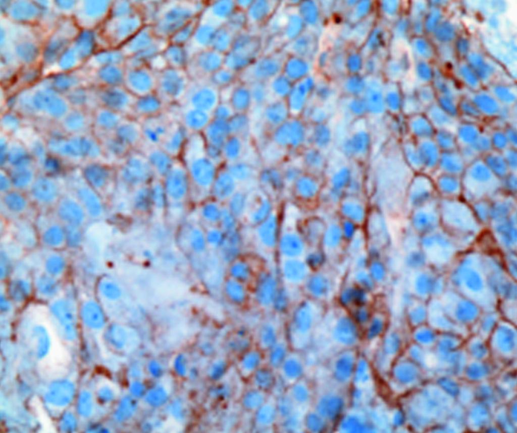 D, Cases scored as IHC 3+ demonstrate circumferential membrane staining in more than 10% of tumor cells, but the staining ring is thick and has a retractile quality (A-D, 400).