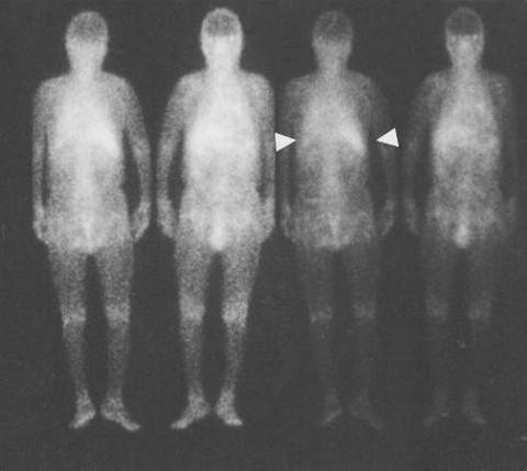Figure 4. Gallium scintigraphy findings (January 1999). Abnormal uptake was seen in the bilateral lower lung fields. No hilar adenopathy or sialadenitis was found. Figure 2.