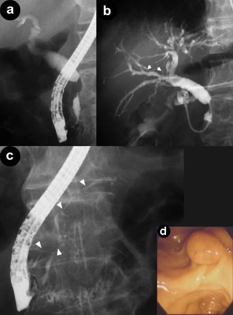 Following ERCP, we performed a transpapillary forceps biopsy. Figure 3. Endoscopic retrograde cholangiopancreatography findings (a. cholangiogram; b.
