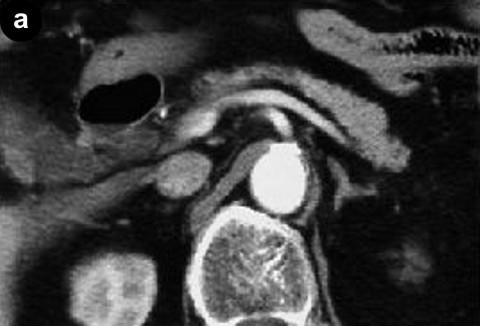 improved further (Figure 5c). Abdominal CT in January 2002 showed atrophy of the pancreas (Figure 6).