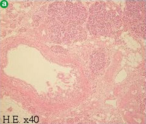 Figure 7. Histology of the autopsy specimens of the pancreas. a. b. Atrophy of the acinar cells and fibrosis. Very little infiltration of inflammatory cells (H&E x40). c. Periductal and interlobular fibrosis clearly seen (Masson x40).