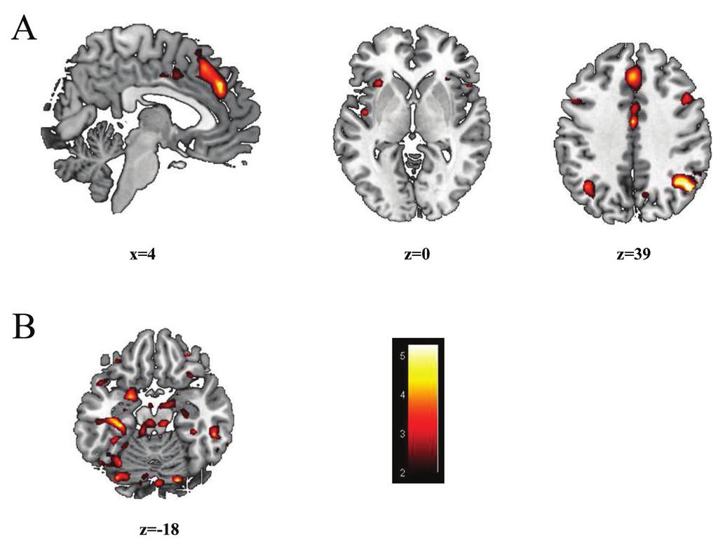 REGIONAL BRAIN ACTIVATION PATTERNS IN SLE Figure 1. Composite activation areas.