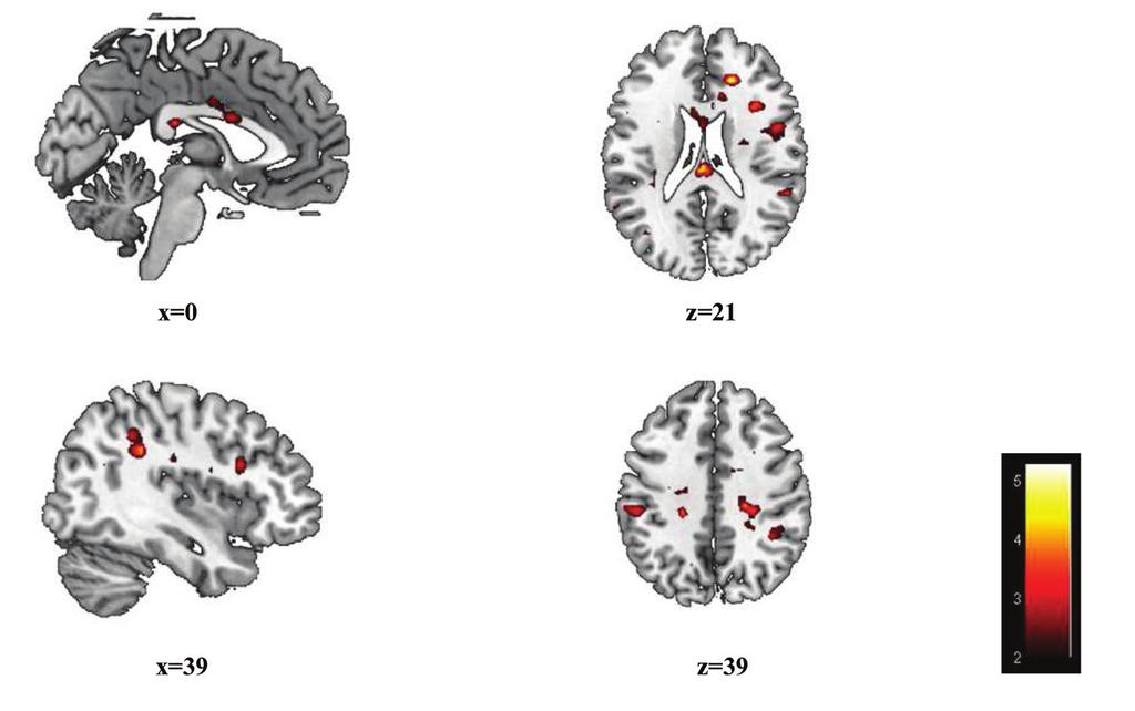 Areas with increased activation include BA40 (supramarginal gyrus, parietal lobe), somatomotor cortex, cingulated gyrus, BA9 (granular/prefrontal area), BA22 (superior temporal; auditory) and BA17