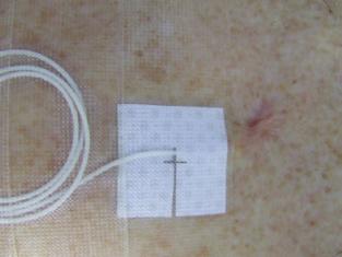 When the infusion segment is cut, it is recommended to make the cut at the edge of the black mark and to record the remaining infusion segment