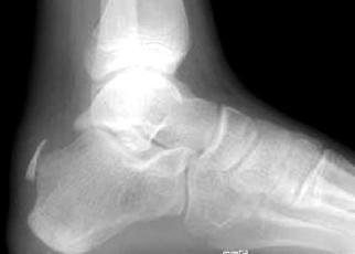 4 cases of calcaneal apophyseal avulsion fractures in soccer player
