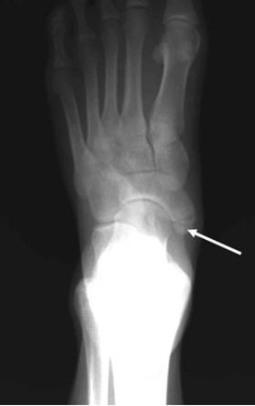 Accessory Navicular bone Congenital anomaly caused by aberrant ossification Relatively common, 4-14% of the