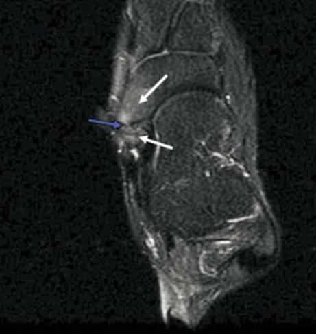 Imaging X-ray 45 eversion oblique view of the foot Technetium bone scan Focal increase in radioactivity 100% sensitive,