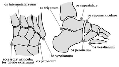 Accessory Ossicles in Foot Possible to identify up to 21 accessory bones 20-30%