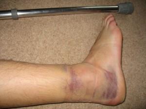 Ankle Sprain Most common sports injury; usually