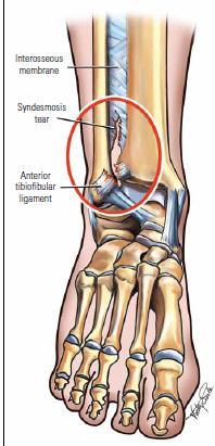 High ankle sprain Tear of the tibiofibular ligaments