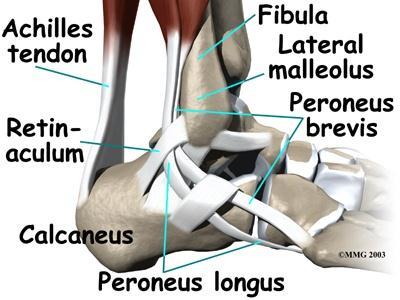 Peroneal Tendonitis Peroneus longus and brevis are evertors and dorsiflexors Causes: recurrent inversion injury, excessive pronation,