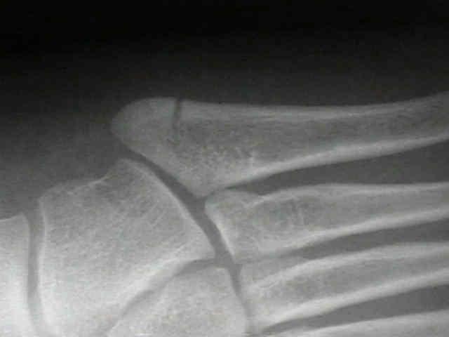 5th Metatarsal Fracture Avulsion fracture Inversion