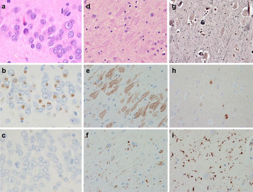Acta Neuropathol (2011) 122:137 153 143 Fig. 4 Histological features of the 3R, 3R? 4R and remaining 4R FTLD-tau molecular pathologies.