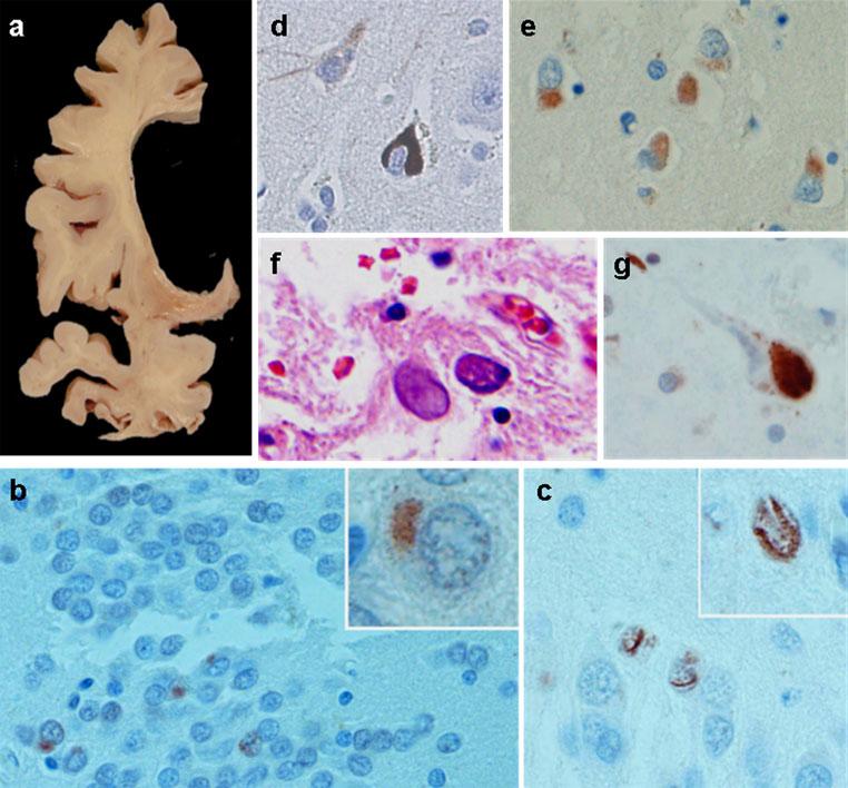 Acta Neuropathol (2011) 122:137 153 145 Fig. 6 Histological features of FTLD-FUS molecular pathologies.