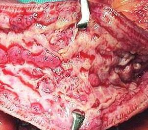 Crohns Disease: