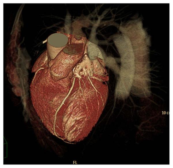 Otero et al. Page 13 Fig. 2. 3D volume rendered image of a 62-year-old man with chest pain. CT was requested and excluded CAD.