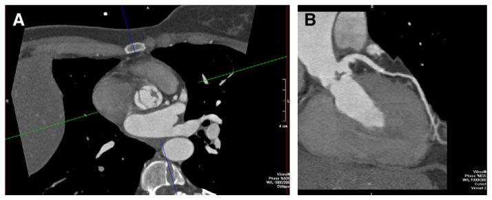 Otero et al. Page 14 Fig. 3. 55-year-old man with abnormal aortic valve motion by echocardiography. CT was requested to exclude CAD.