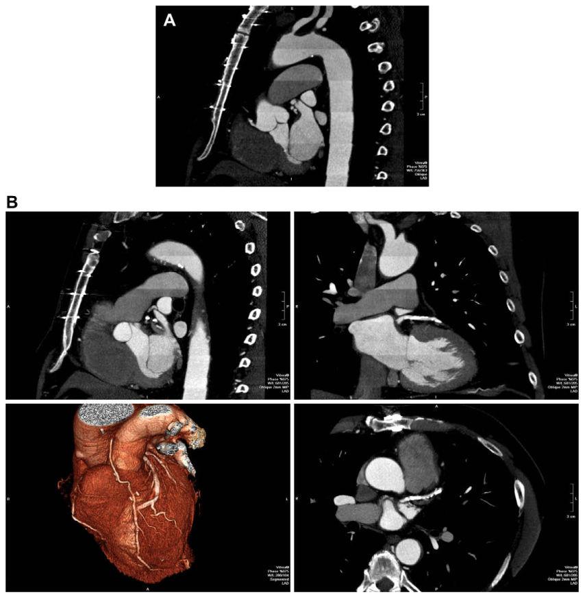 Otero et al. Page 15 Fig. 4. 72-year-old man status post coronary artery bypass grafting.