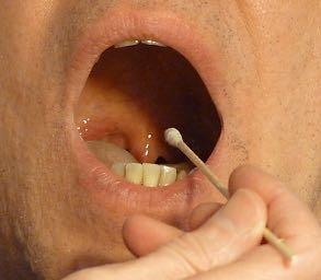 CN IX: GLOSSOPHARYNGEAL CN X: VAGUS Sensory and motor for each Interconnected so tested together Ask about swallowing difficulty and changes in voice Check the gag